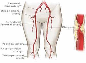 下肢动脉硬化闭塞症