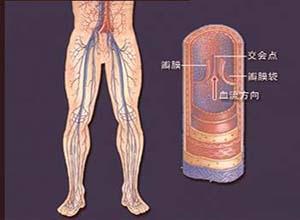 下肢交通静脉瓣膜关闭不全