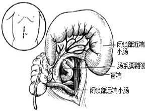 先天性肠闭锁