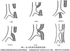 先天性食管重复