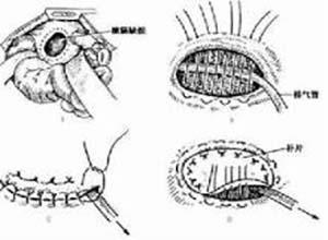 先天性胸腹裂孔疝