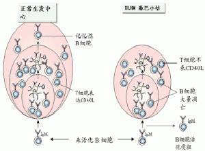 小儿X-连锁严重联合免疫缺陷病