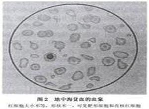 小儿β地中海贫血