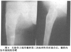 小儿单房性骨囊肿