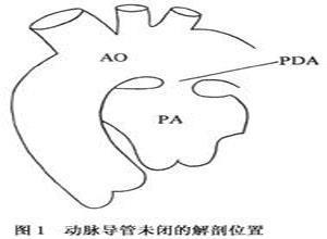 小儿动脉导管未闭