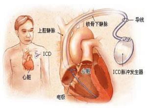 小儿窦性心律失常