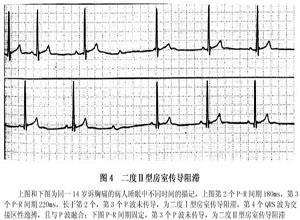 小儿房室传导阻滞