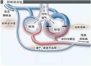 肝肺综合症