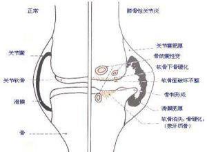 小儿黑酸尿综合征