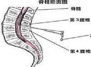 小儿急性横贯性脊髓炎