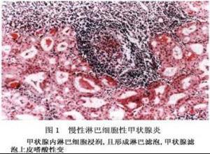 小儿急性化脓性甲状腺炎