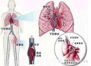 小儿抗磷脂综合征