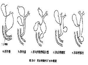 小儿先天性胆总管囊肿