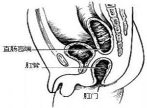 小儿先天性直肠肛门畸形