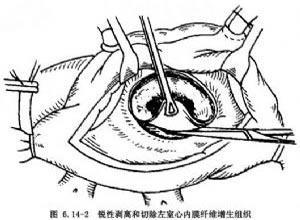 小儿心内膜弹力纤维增生症