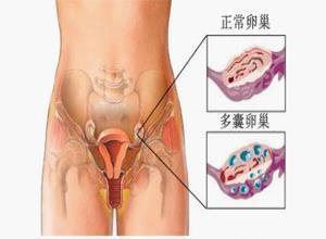 小儿雄激素不敏感综合征