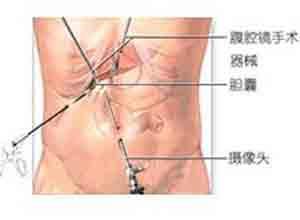 急性化脓性胆管炎