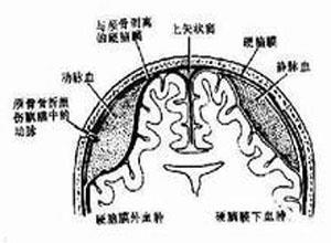 小儿硬脑膜外血肿