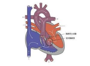 小儿右室双出口