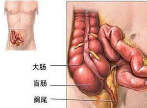 小儿原发性腹膜炎