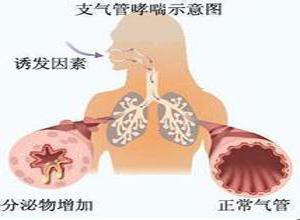 小儿支气管哮喘