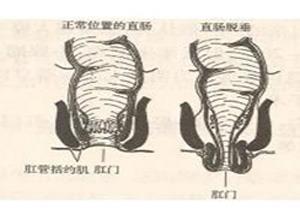 小儿直肠脱垂