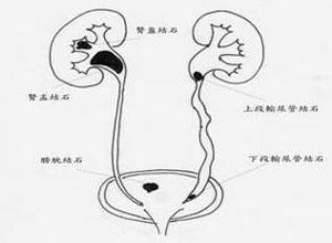 新生儿泌尿系统感染