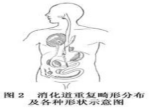 新生儿消化道重复症