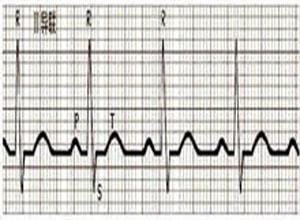 新生儿心律失常