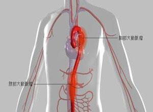 胸腹主动脉动脉瘤