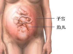 羊膜腔感染综合征