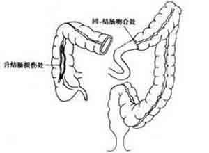 结肠损伤