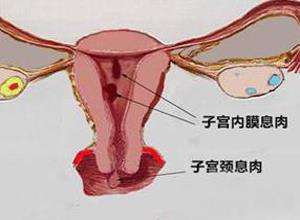 阴道子宫内膜间质肉瘤