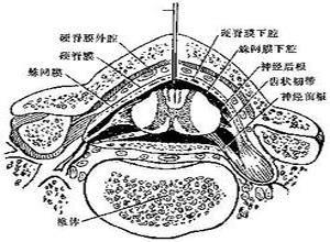 硬脊膜下脓肿