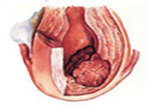 原发性腹膜癌