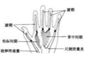 掌侧化脓性腱鞘炎、滑囊炎和深间隙感染