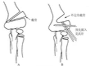 肘内翻畸形