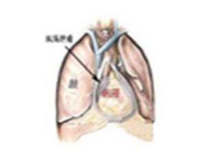 纵隔囊肿及肿瘤