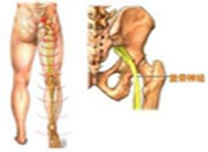 坐骨神经损伤