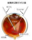玻璃体疝