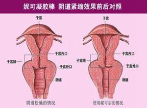 阴缩