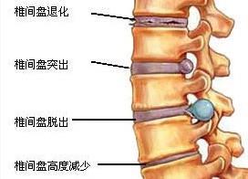 腰椎病