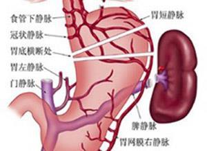 特发性非硬化性门脉高压综合征