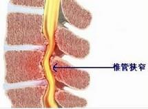 椎管狭窄