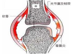 滑膜炎