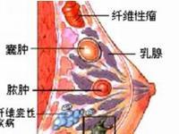 乳腺囊肿