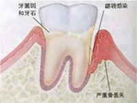 青春前期牙周炎