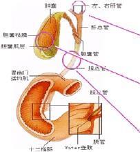 胆管结石