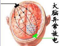 女性癫痫