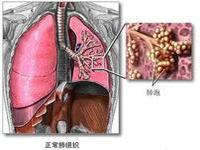 小细胞肺癌